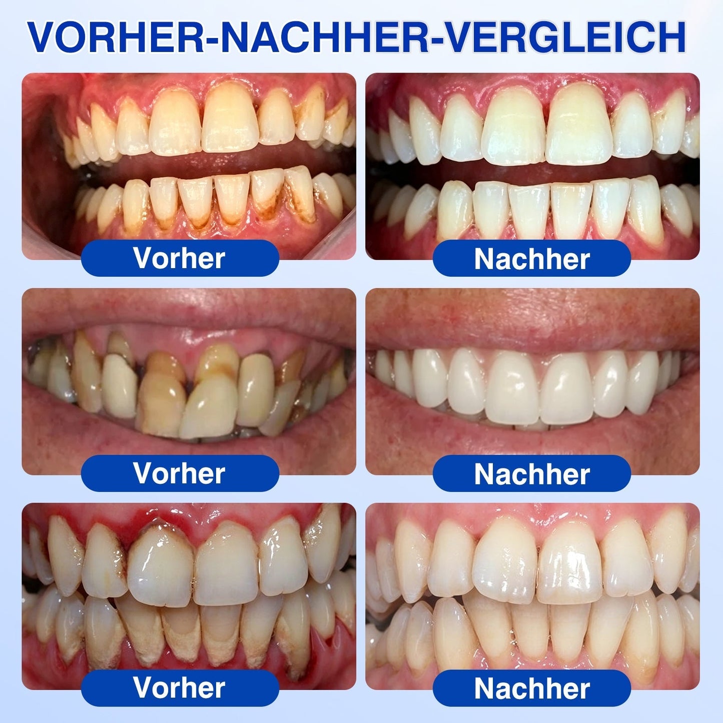 CleraNaure®💎 GumRevive – fejlett gél az íny és a fogágy ápolására🇭🇺👨‍⚕️