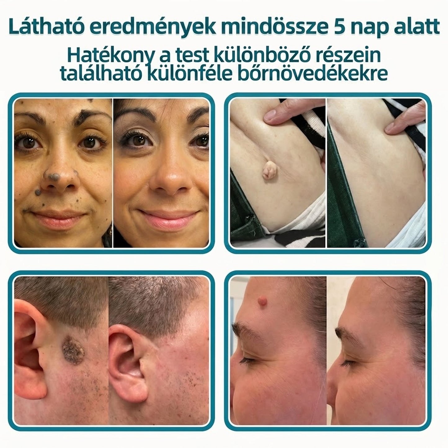 🎉🇭🇺 Healrize® 2 az 1-ben mikrotűs + hidrokolloid tapasz 🤩| Anyajegy, pattanás, lapos szemölcs és bőrkinövés ápolására | Ráncok, hegek és bőrhibák megjelenésének javítására | Láthatatlan tapasz arcra és testre