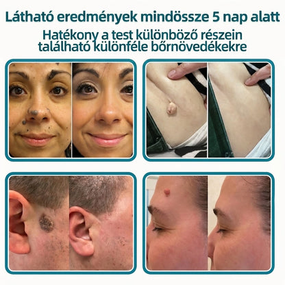 🎉🇭🇺 Healrize® 2 az 1-ben mikrotűs + hidrokolloid tapasz 🤩| Anyajegy, pattanás, lapos szemölcs és bőrkinövés ápolására | Ráncok, hegek és bőrhibák megjelenésének javítására | Láthatatlan tapasz arcra és testre