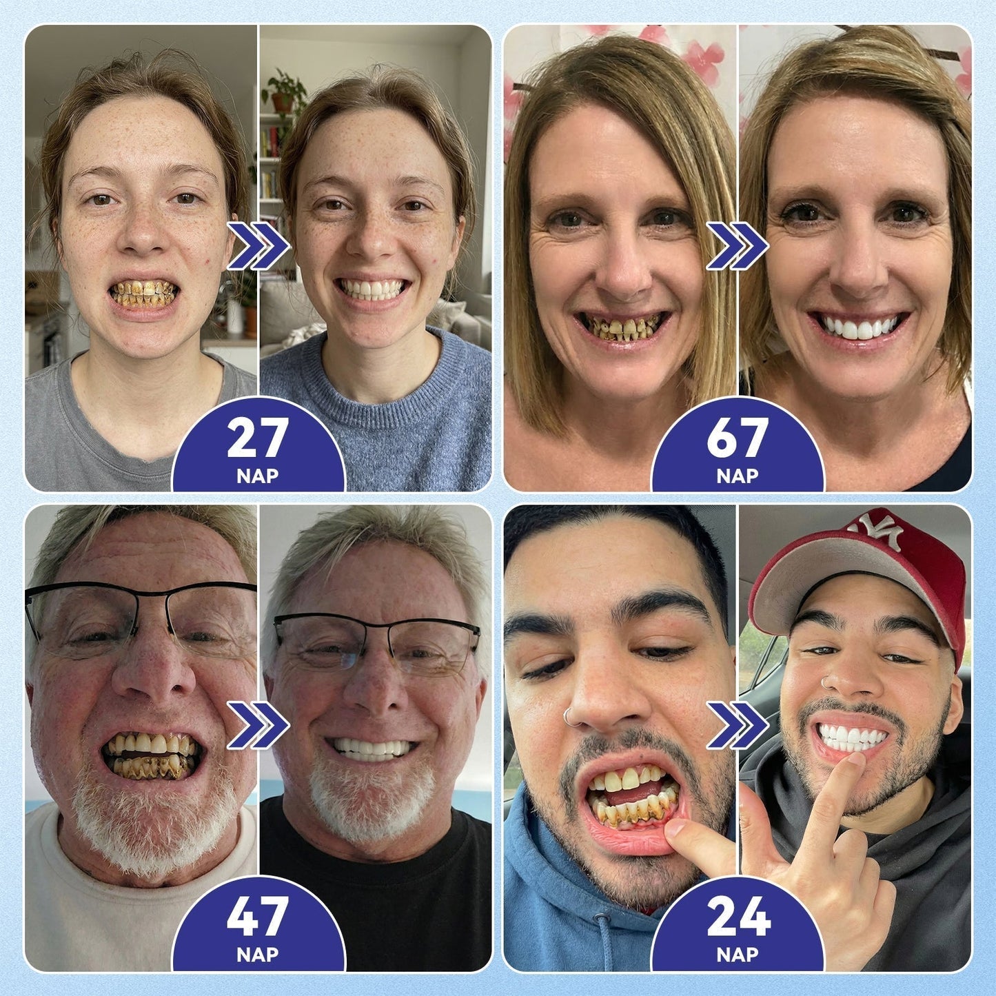🦷🦷CleraNaure® Tideglusib Fog & íny Javító mikrotűs tapasz | Fejlett őssejt-aktiváló fogcsíkok (újjáépíti a fogzománcot és a dentint • erősíti az ínyt • megszünteti a fogkövet és a szagokat • megállítja a fogérzékenységet)3.0🦷