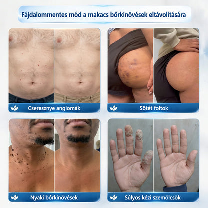 🛡️Hivatalos áruház🎉CleraNaure® 7 napos pigmentfolt- és bőrhiba-eltüntető kezelés (Fájdalommentes, hegmentes görgős applikátor)🛡️🛡️