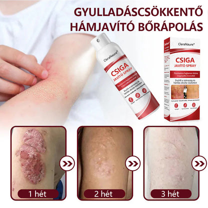 CleraNature® Bálnazsír Spray Viszkető, Hámló Psoriasisra Hajlamos Bőrre⭐⭐